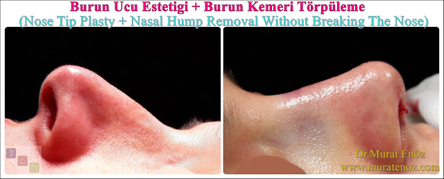 Rhinoplasty Without Breaking Nasal Bone - Rhinoplasty Without Breaking Nasal Bone - Female Nose Aesthetic Surgery - Nose Jobs For Women - Nose Reshaping for Women - Female Rhinoplasty Istanbul - Nose Job Surgery for Women - Women's Rhinoplasty - Nose Aesthetic Surgery For Women - Female Rhinoplasty Surgery in Istanbul - Female Rhinoplasty Surgery in Turkey