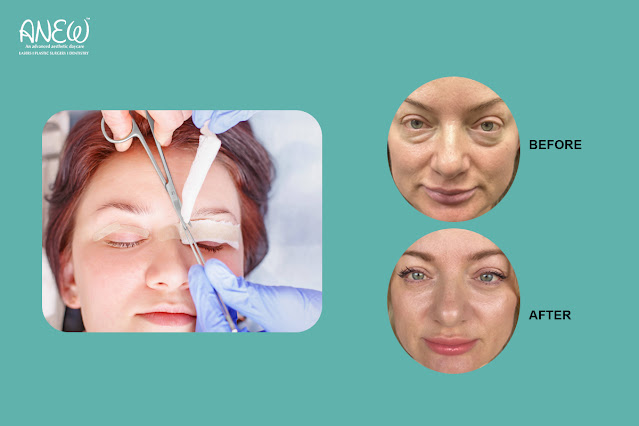 eyelid surgery