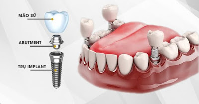 Quy trình cấy ghép răng implant như thế nào? 1