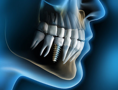 Mất răng hàm số 6 – Khắc phục hiệu quả bằng cấy ghép implant