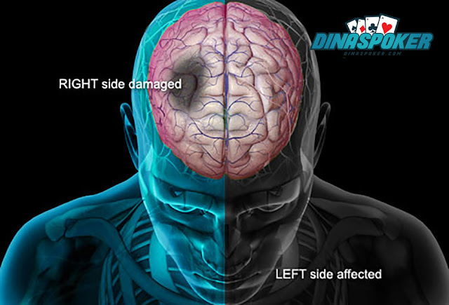 Finding the Best How to Treat Stroke