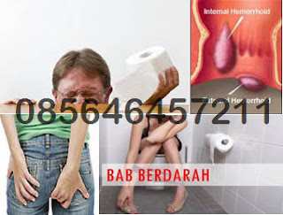 AmbeJOSS Obat Hemoroid Bentuk Kapsul