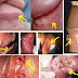 Obat kutil di kelamin manjur thumbnail