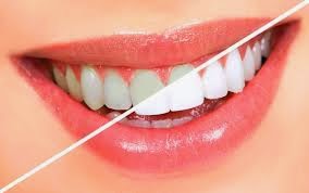 http://www.dental-clinic-delhi.com/teeth-whitening.html