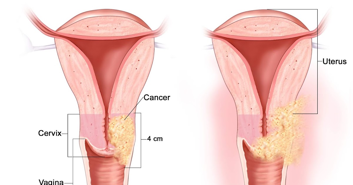 Can the early symptoms of cervical cancer be prevented ...