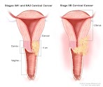 What Are The Earliest Symptoms Of Cervical Cancer - Cervical Cancer Causes Symptoms Prevention and Treatment ... / The cause of a symptom may also be a different medical condition that is not cancer, which is why people.