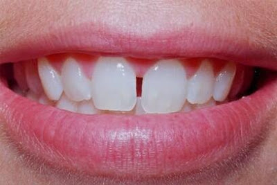 Có nên khắc phục răng thưa không?