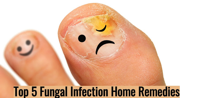 Top 5 Fungal Infection Home Remedies
