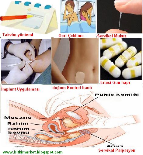 Doğum kontrol yöntemleri bant ile ilgili görsel sonucu