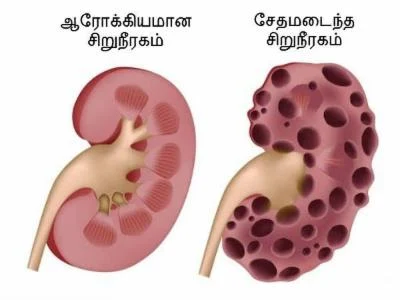 சிறுநீரகங்களை சேதப்படுத்தும் 13 பழக்க வழக்கங்கள் !