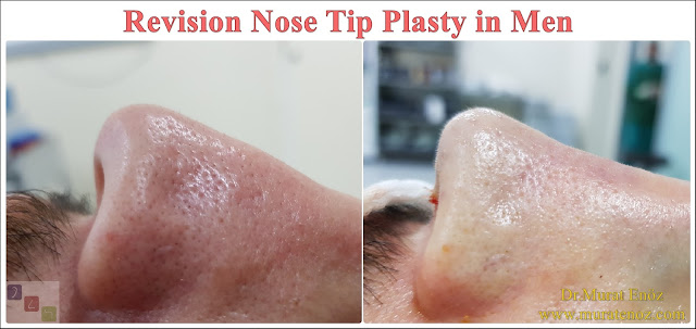 Revision Nose Tip Plasty in Men - Revision Nose Tip Surgery For Men - Revision Male Nose Tip Plasty Operation in Istanbul - Men's Nose Tip Plasty - Revision Nose Tip Reshaping For Men - Mens Nose Tip Plasty in Turkey - Revision Nose Tip Plasty For Men - Revision Nose Tip Plasty For Men Istanbul - Revision Nose Tip Aesthetic for Men - Revision Male Nose Tip Plasty Operation - Revision Male Nose Tip Plasty Surgery in Istanbul - Male Nose Tip Plasty Surgery in Turkey - Revision Male Nose Tip Aesthetic Surgery - Revision Nose Tip Plasty In Mens Istanbul