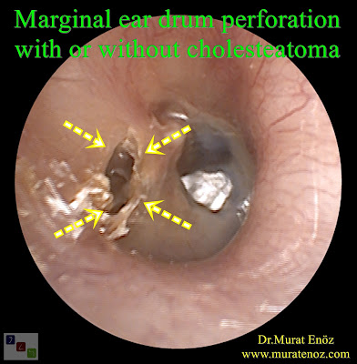 Marginal eardrum perforation with retraction pocket