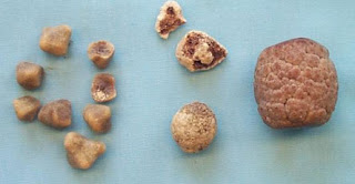 What are gallstones?