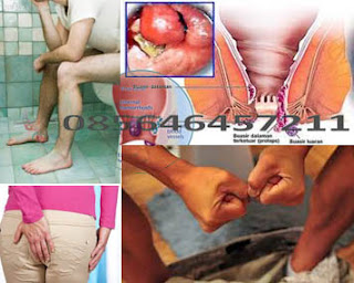 Obat Herbal Wasir Ambejoss Berkhasiat