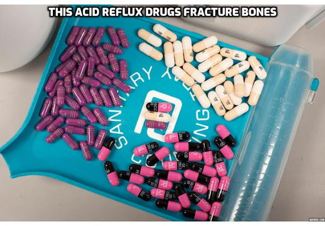 Getting Rid of Acid Reflux Permanently - This Acid Reflux Drugs Fracture Bones. It is common for infants to spit up their food after a meal, but if they also vomit, cough, and choke frequently, struggle to eat, and fail to gain weight, then a well-meaning doctor may decide to prescribe a drug for acid reflux. But a study just published in the journal Pediatrics shows that these drugs also put your child at risk of bone fractures early in their lives.