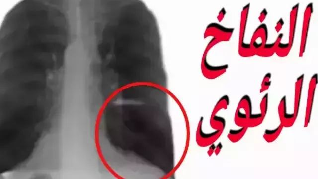 حالة مرضية تصيب الرئة وتؤدي إلى قصر في النفس وصعوبة في ممارسة النشاطات