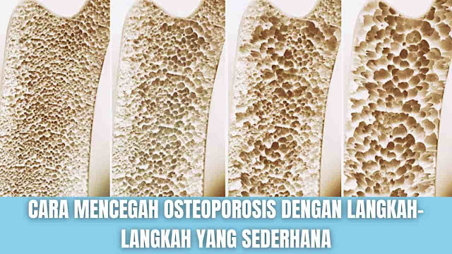 Cara Mencegah Osteoporosis Dengan Langkah-Langkah Yang Sederhana Apa Itu Osteoporosis ? Osteoporosis adalah sebuah kondisi yang menyebabkan tulang menjadi lemah dan rapuh sehingga apabila terjatuh atau bahkan tekanan ringan seperti membungkuk atau batuk dapat menyebabkan patah tulang. Fraktur terkait osteoporosis paling sering terjadi di pinggul, pergelangan tangan, atau tulang belakang.  Tulang adalah sebuah jaringan hidup yang terus-menerus dipecah dan diganti. Osteoporosis terjadi ketika pembentukan tulang baru tidak mengikuti hilangnya tulang yang lama.  Osteoporosis mempengaruhi pria dan wanita dari semua ras. Akan tetapi wanita dengan kulit putih dan tinggal di benua Asia, terutama wanit yang lebih tua yang telah melewati masa menopause, berada pada risiko tertinggi. Dengan rutin berolahraga seperti menahan menahan beban, dapat mencegah pengeroposan tulang dan memperkuat tulang.    Penyebab Penting untuk diketahui bahwa tulang berada dalam kondisi pembaruan yang konstan, tulang baru dibuat dan tulang lama dihancurkan. Ketika masih mudah, tubuh membuat tulang baru lebih cepat daripada memecah tulang tua dan massa tulang Anda meningkat. Namun setelah awal usia 20-an, proses ini melambat, dan kebanyakan orang mencapai puncak massa tulang pada usia 30 tahun. Seiring bertambahnya usia, massa tulang hilang lebih cepat daripada pembentukannya.  Besaran kemungkinan terkena kondisi osteoporosis bergantung pada seberapa banyak massa tulang yang Anda capai di masa muda. Massa tulang puncak sebagian diwariskan dan bervariasi juga menurut kelompok etnis. Semakin tinggi massa tulang puncak Anda, maka semakin banyak massa tulang yang Anda miliki dan semakin kecil kemungkinan terkena osteoporosis seiring bertambahnya usia.    Gejala Pada tahap awal tidak ada gejala yang ditimbulkan dari kondisi ini. Akan tetapi begitu tulang melemah akibat dari osteoporosis, kemungkinan akan memiliki gejala seperti:  Sakit punggung, yang disebabkan oleh tulang belakang yang patah atau kolaps Kehilangan tinggi badan dari waktu ke waktu Postur bungkuk Tulang menjadi lebih mudah patah    Cara Pencegahan Osteoporosis Ada banyak faktor risiko dari osteoporosis yang tidak dapat dikendalikan. Hal ini termasuk jenis kelamin perempuan, semakin tua, dan memiliki riwayat keluarga osteoporosis. Akan tetapi, ada beberapa faktor yang bisa Anda kendalikan. Berikut beberapa cara untuk mencegah terkena osteoporosis yang meliputi:  Mendapatkan jumlah kalsium dan vitamin D yang direkomendasikan setiap hari Melakukan latihan menahan beban atau berolahraga secara rutin seperti berjalan, jogging, lompat tali, memanjat tangga Berhenti merokok Untuk wanita, harus menimbang/memikirkan pro dan kontra dari terapi hormon  Perlu diketahui, jika Anda sudah terkena osteoporosis silahkan konsultasikan ke dokter untuk menanyakan cara terbaik untuk mencegahnya dan mendapatkan penanganan yang lebih baik.