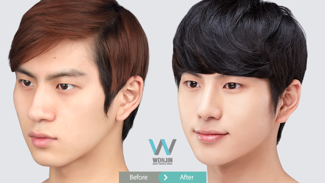 Rhinoplasty in Korea