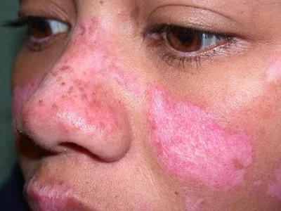 lupus sign