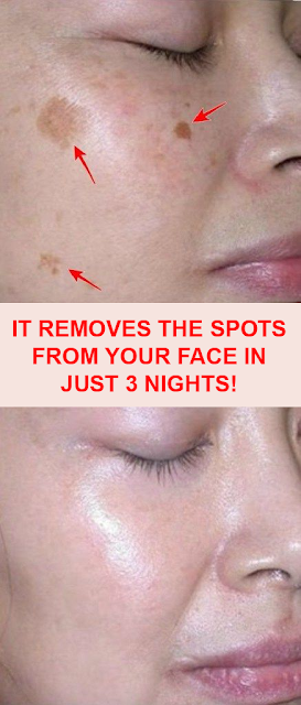 IT REMOVES THE SPOTS FROM YOUR FACE IN JUST 3 NIGHTS!