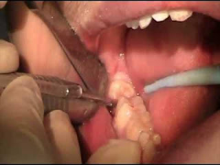 Wisdom Teeth Removal