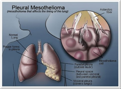 Mesothelioma Survival Rates