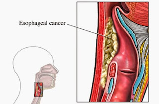 Esophageal Cancer - Forerunners Healthcare Medical Consultants
