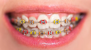 Các loại niềng răng phổ biến-2