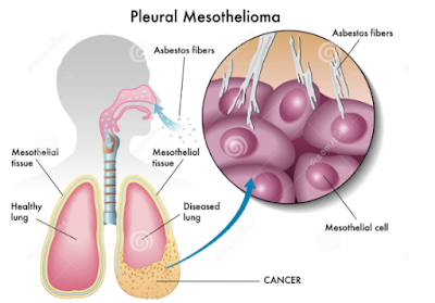 Pleural Mesothelioma Cancer | Prognosis, Symptoms & Diagnosis, Treatment