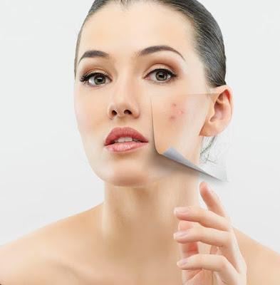 woman-with-acne ,كيف تتخلصين من حب الشباب نهائيا