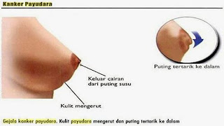 Pengobatan Kanker Payudara Awal, Pengobatan Kanker Payudara Di Surabaya, Jenis Obat Herbal Kanker Payudara, Obat Tradisional Untuk Menyembuhkan Kanker Payudara, Operasi Kanker Payudara Stadium 4, Kanker Payudara Tanpa Ada Benjolan, Kanker Payudara Askep, Pengobatan Alternatif Kanker Payudara Di Jakarta, Obat Herbal Bagi Penderita Kanker Payudara, Obat Alami Untuk Kanker Payudara, Cara Pengobatan Kanker Payudara Stadium 3, Www.Obat Kanker Payudara, Obat Kanker Payudara Sirih Merah, Obat Kangker Payudara Apa, Kanker Payudara Ppt, Herbal Untuk Mengobati Kanker Payudara, Jamu Herbal Kanker Payudara, Penderita Kanker Payudara Hamil, Ramuan Tradisional Mengobati Kanker Payudara, Obat Manjur Untuk Kanker Payudara, Kanker Payudara Akibat Merokok, Pengobatan Kanker Payudara.Com, Kanker Payudara Makalah, Herbal Kanker Payudara Stadium 4, Obat Kanker Payudara Terbaik, Kanker Payudara Cara Mendeteksi, Kanker Payudara Facebook, Herbal Ampuh Untuk Kanker Payudara, Operasi Kanker Payudara Gratis, Www Obat Herbal Kanker Payudara, Kanker Payudara Mengeras, Kanker Payudara Hormonal, Kanker Payudara Dan Obesitas 