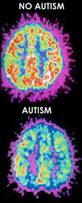 NO autism! Det är som att säga 'ett huvud utan hål i!'