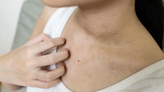 Ποιοι καρκίνοι προκαλούν φαγούρα στο δέρμα