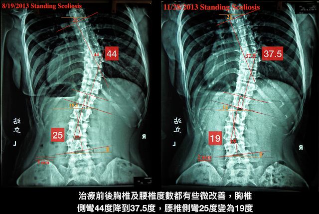 脊椎側彎, 脊椎側彎矯正, 脊椎側彎治療, 脊椎側彎 復健, 脊椎側彎 瑜珈