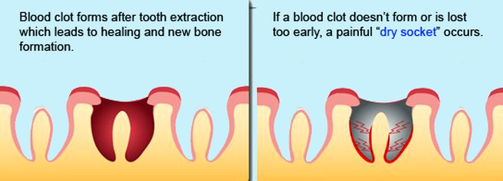 Dry Socket
