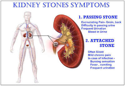 Symptoms of Attached & Passing Kidney Stone