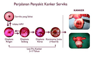 Obat Kanker Serviks Dengan Ekstrak Sirsak Dan Sarang Semut