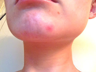 cystic acne