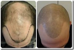 Hair Restoration