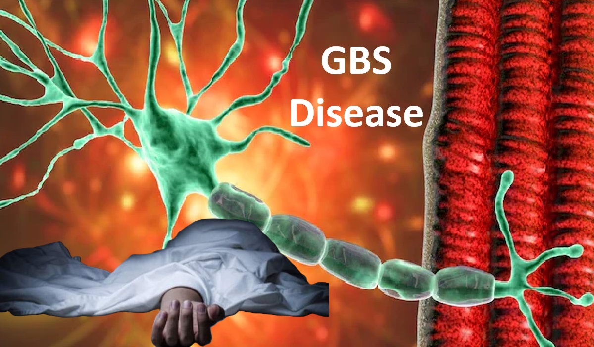 Maharashtra में GBS का प्रकोप : एक और मरीज की मौत, जानें लक्षण और बचाव के उपाय