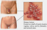 Obat Herpes Kulit vital