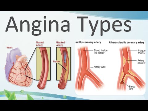 WHAT IS ANGINA? IS ANGINA DANGEROUS? CAUSES, SYMPTOMS, TYPES OF ANGINA, AIS ANGINA HEREDITARY? UNSTABLE ANGINA, DIAGNOSIS, TREATMENT