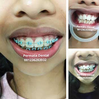 gambar foto behel bracket kawat gigi sebelum dan sesudah perawatan untuk memperbaiki merapikan gigi gingsul gigi miring renggang tonggos berantakan keluar masuk jarang diastema maju mundur tidak rapi tidak beraturan bali denpasar banyuwangi jember tidak rata kocar kacir