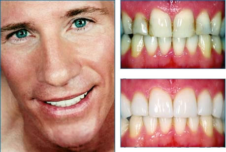 Its All About Healthy: What are Po   rcelain Veneers and Who Needs Them?