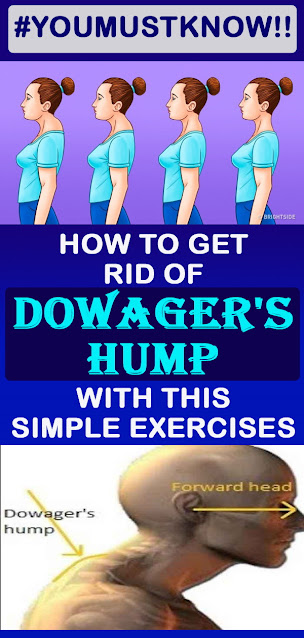 How To Get Rid Of Dowager's Hump With This Simple Exercises