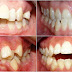 Những yếu tố ảnh hưởng đến thời gian niềng răng khểnh?