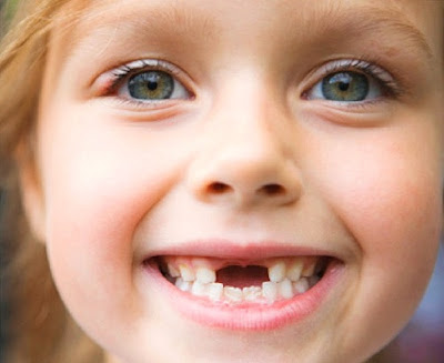 Nguyên nhân răng mọc lệch ở trẻ em