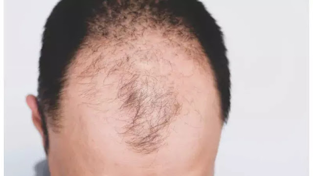 benefits of baldness