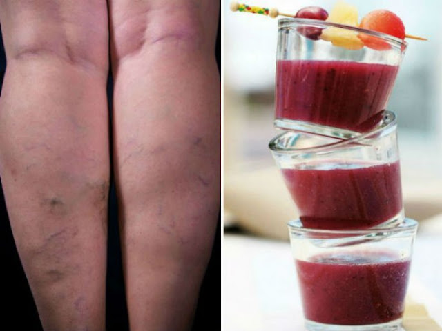 3 smoothies contre les varices, éliminez-les en 1 mois