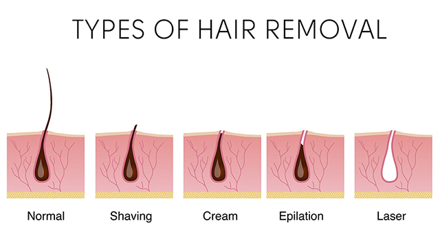 Hair Removal Laser Treatment Terbaik Di Klinik Dr Bazilah Bangi